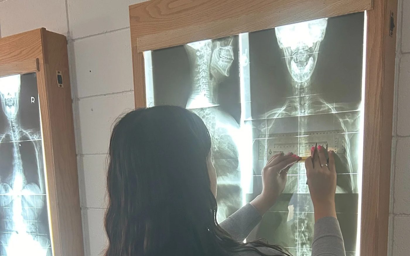Reviewing spinal X-rays as part of Gonstead analysis